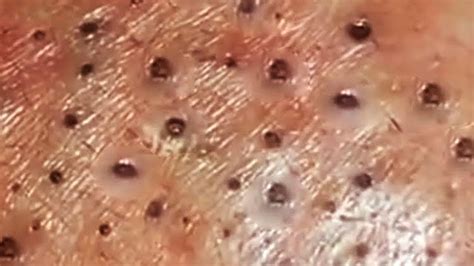 Deep blackhead pops - how to skincarepopping big pimplescystic acne removal close updilated pore of winer pimple popper blackhead on facewhiteheads around noseblackhead whiteheads...